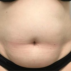 TruSculpt ID Before & After Patient #1567